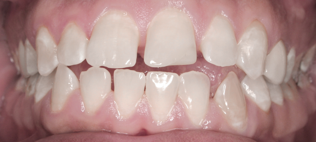 Ortodontia - Antes e Depois